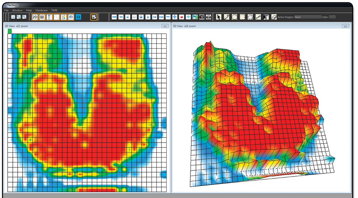 Wheelchair seating pressure mapping showing ischial tuberosity pressure zones
